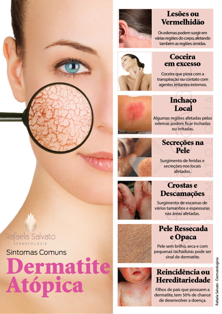 dermatite atópica infografico Rafaela Salvato Dermatologia